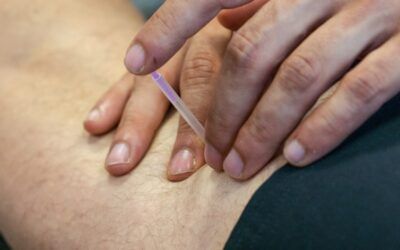 Dry needling bij kaakpijn – dé oplossing voor gespannen kaakspieren!